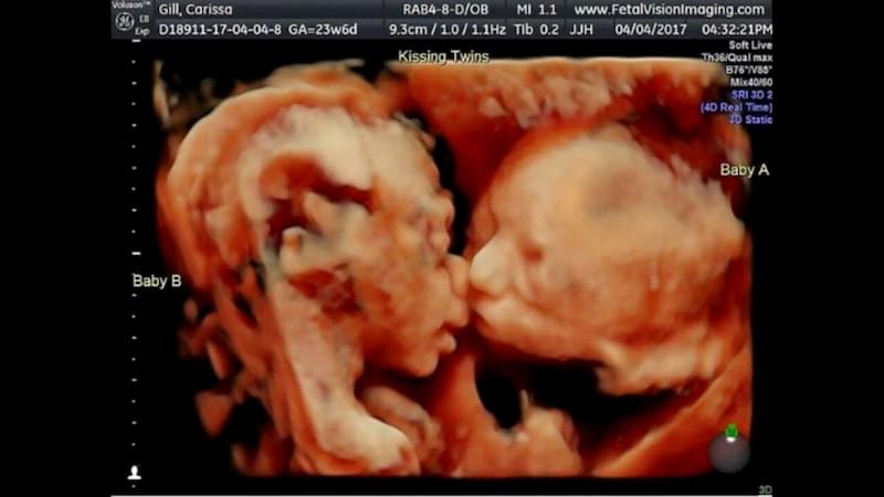 Двуплодная беременность